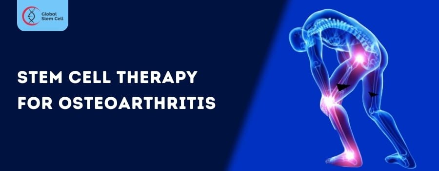 Stem Cell Therapy for Osteoarthritis